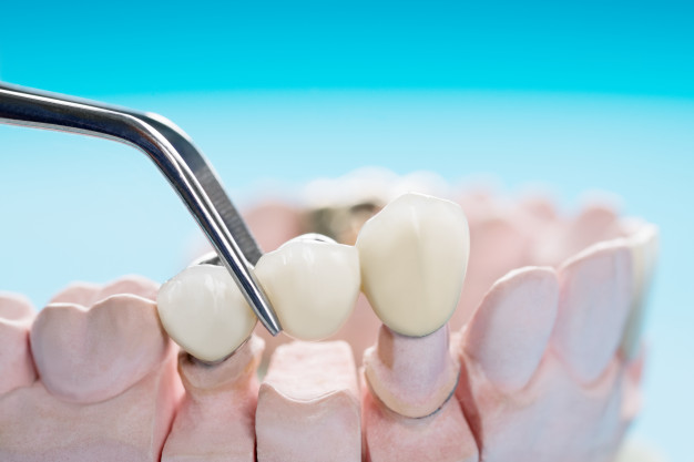 namestitev zobnih lusk