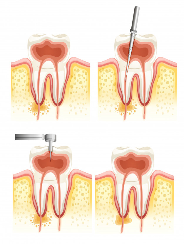 endodontija1