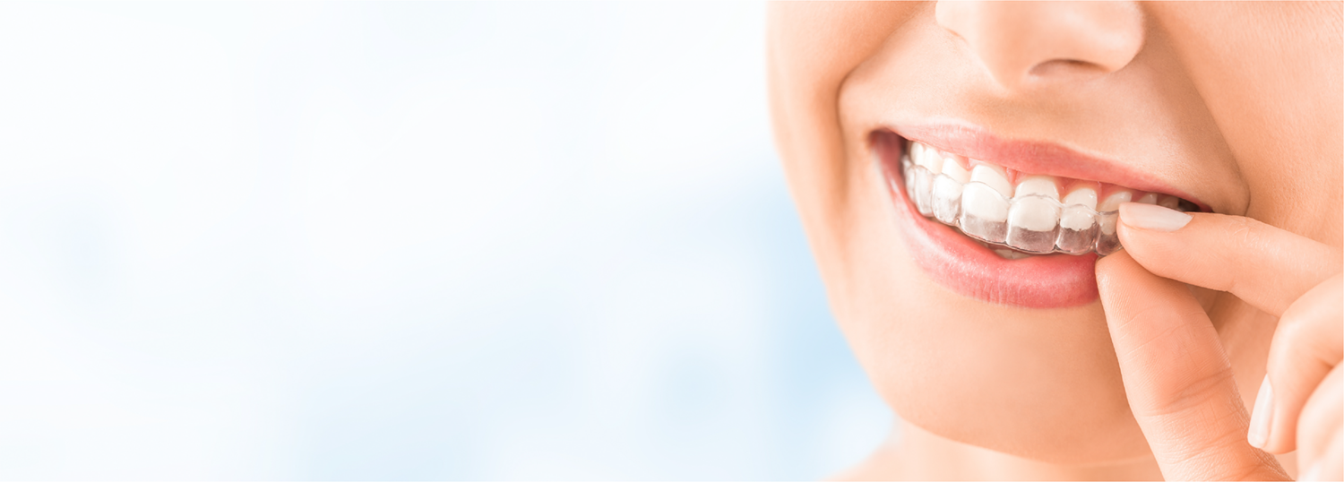 nevidni zobni aparat cena – Lux Dental